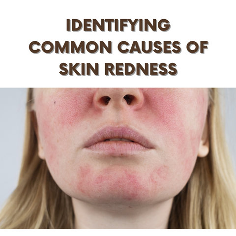 Identifying Common Causes of Skin Redness