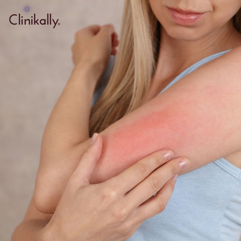 Allergic