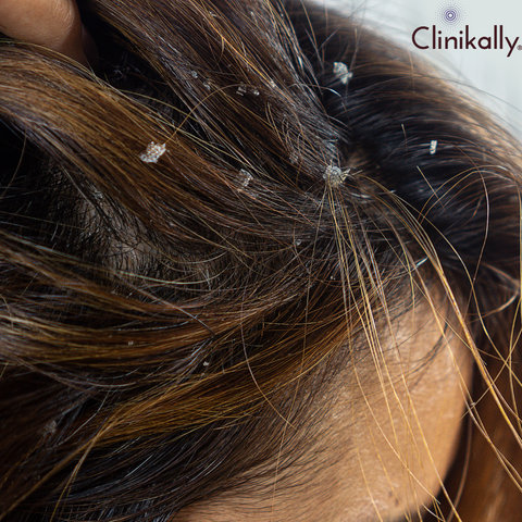 HAIR ALLERGY WITH SHAMPOO
