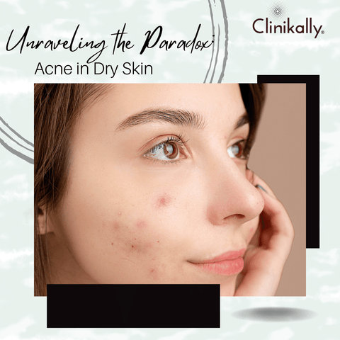 dry skin acne