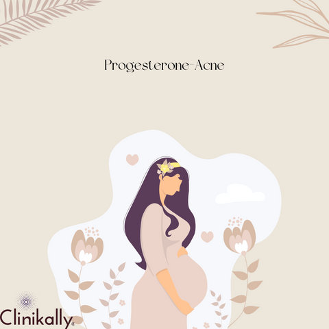Progesterone-Acne