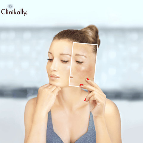Addressing Hyperpigmentation with Niacinamide