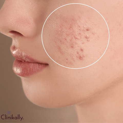 Targeting Common Skin Concerns with Niacinamide