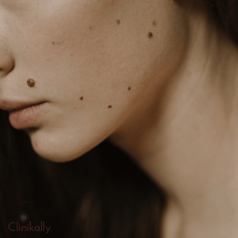 What Is a Beauty Mark?