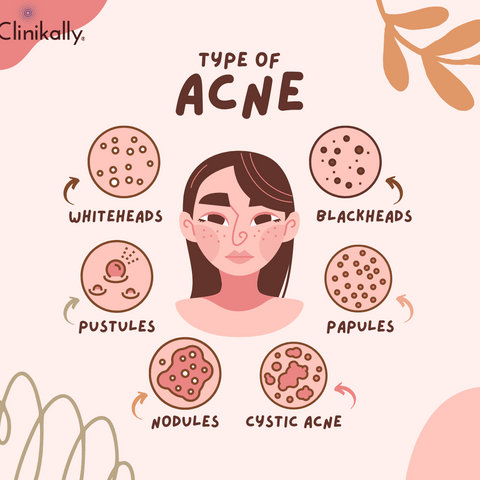 Different Types of Acne and Their Significance