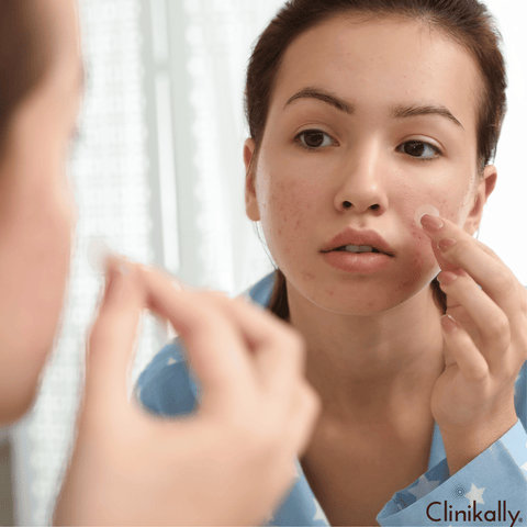 Managing Acne: Skincare and Lifestyle Tips