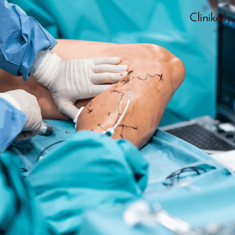 How Spider Vein Treatments Work: Mechanisms and Expected Results
