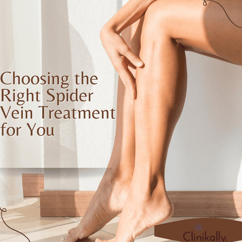 Choosing the Right Spider Vein Treatment for You
