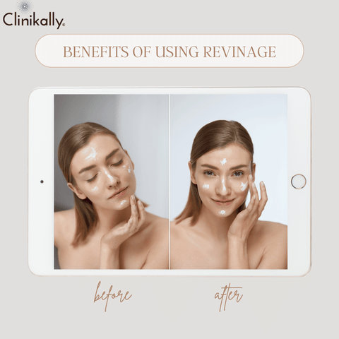 The Benefits of Using Revinage