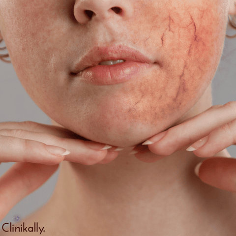 Rosacea: An Overview