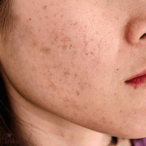 Alcohol and Its Effects on Rosacea