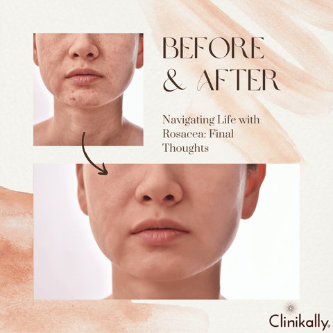 Navigating Life with Rosacea: Final Thoughts