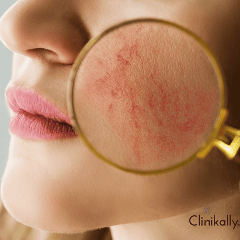 skin treament