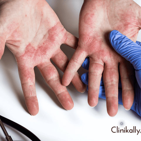 skin irritation
