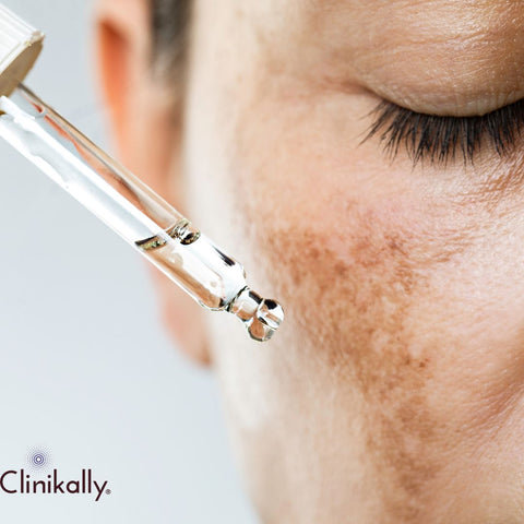 Understanding Hyperpigmentation