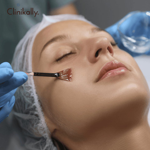 Chemical peels