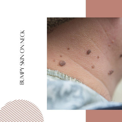 Bumpy Skin on Neck