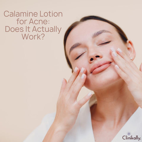 Calamine Lotion for Acne: Does It Actually Work?