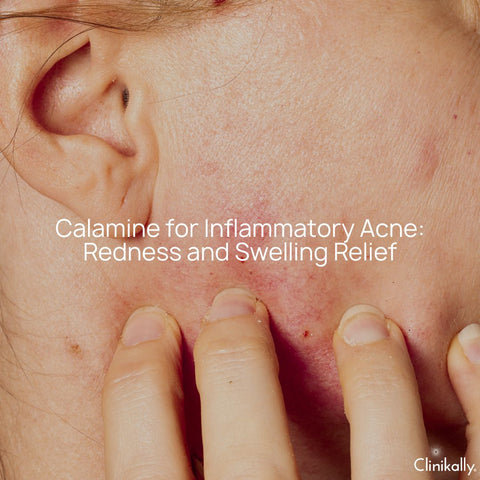 Calamine for Inflammatory Acne: Redness and Swelling Relief