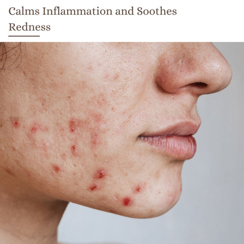 Calms Inflammation and Soothes Redness