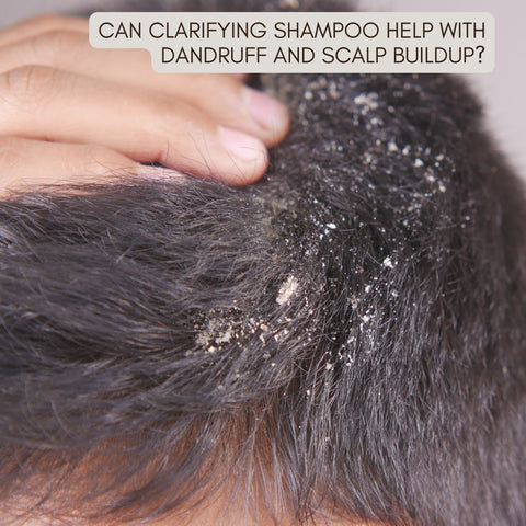 Can Clarifying Shampoo Help with Dandruff and Scalp Buildup?