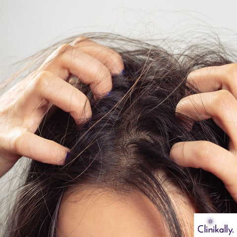 Itchy scalp with dandruff flakes