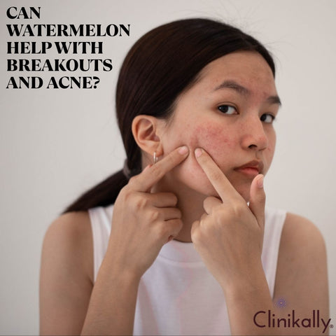 Can Watermelon Help with Breakouts and Acne?