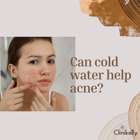 Can cold water help acne?