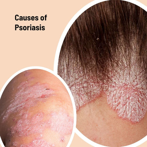 Causes of Psoriasis