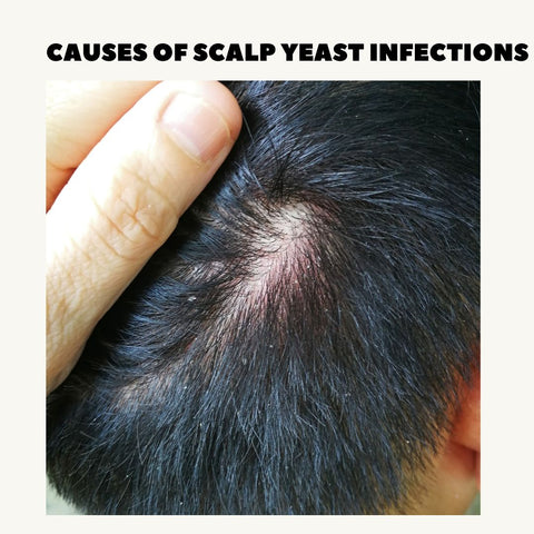 Causes of Scalp Yeast Infections