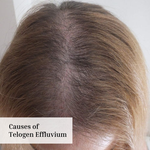 Causes of Telogen Effluvium