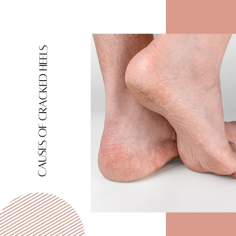 Causes of cracked heels