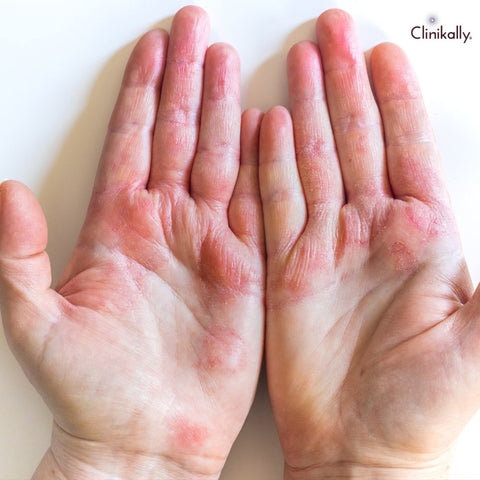 Cetyl Alcohol in Eczema Treatment