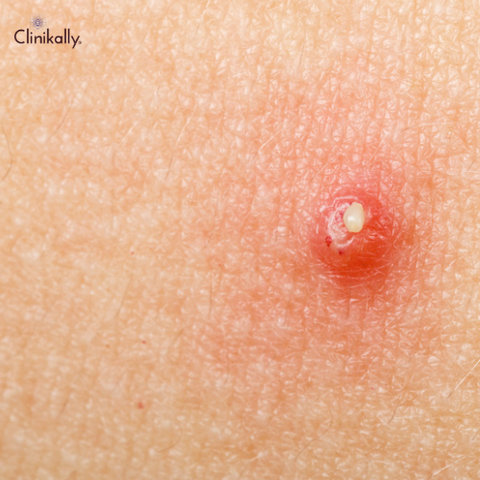 Chest Acne Causes, Treatments, and Prevention
