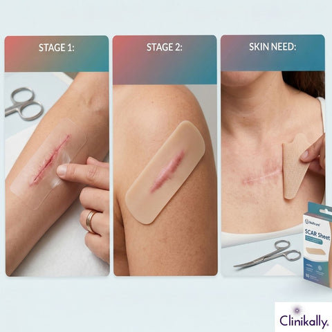 Scar sheet application stages showing silicone tape on healing scars