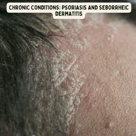 A person's forehead with white flakes all over his scalp. The text on the image is "Chronic Conditions: Psoriasis and Seborrheic Dermatitis"