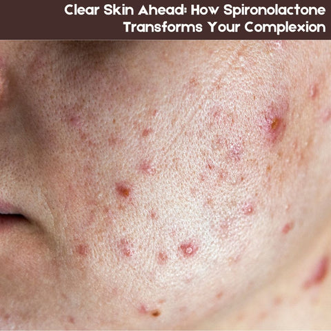 Clear Skin Ahead: How Spironolactone Transforms Your Complexion