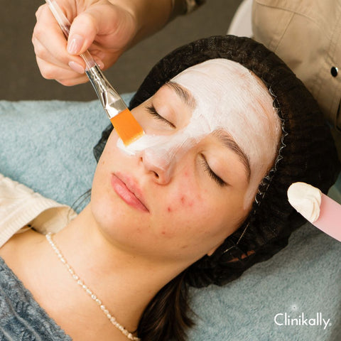 Colloidal oatmeal for acne