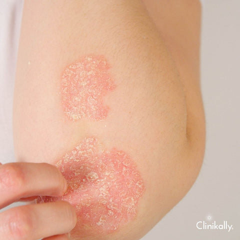 Colloidal oatmeal for eczema