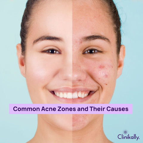 Common Acne Zones and Their Causes