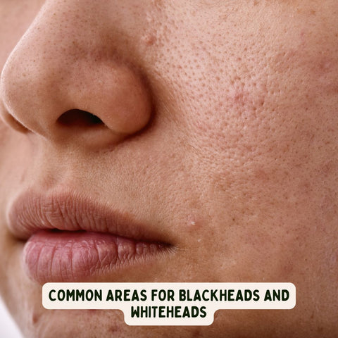 Common Areas for Blackheads and Whiteheads