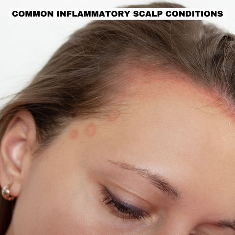 A women with redness all over her scalp, and forehead. The text on the image is "Common Inflammatory Scalp Conditions"
