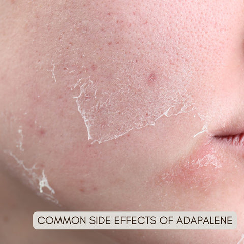 Common Side Effects of Adapalene