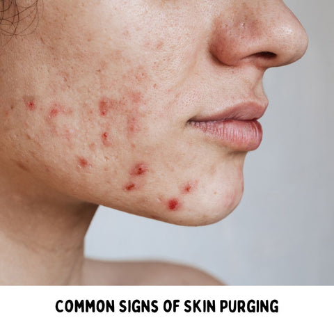 Common Signs of Skin Purging