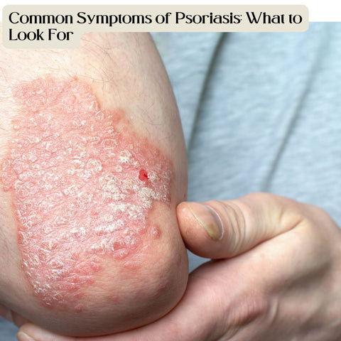 Common Symptoms of Psoriasis: What to Look For