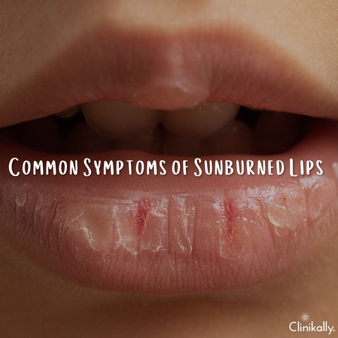 Common Symptoms of Sunburned Lips