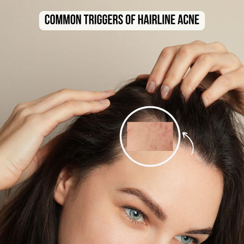 Common Triggers of Hairline Acne