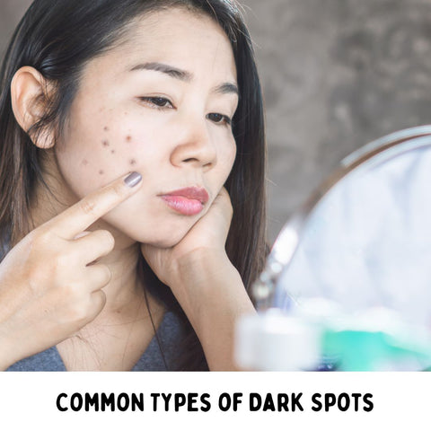 Common Types of Dark Spots