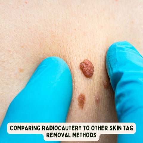 Comparing Radiocautery to Other Skin Tag Removal Methods