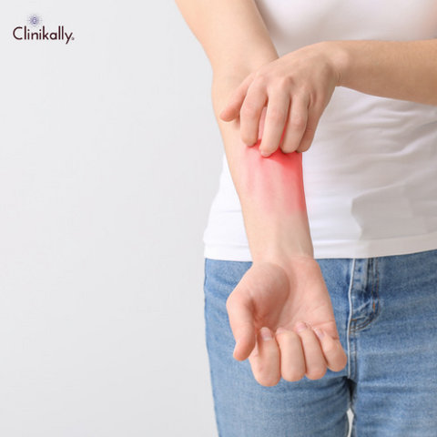 Heat Rash in Adults Causes, Symptoms, and Effective Treatments